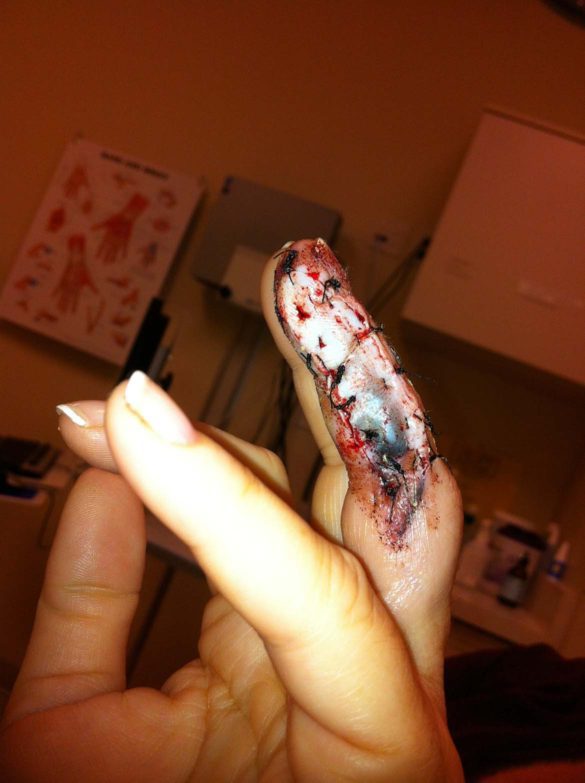 Finger Injury 4 of 4